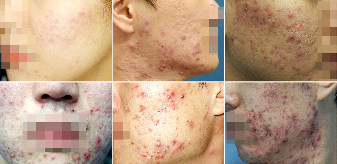 To prevent acne scars in active oriental medicine clinics