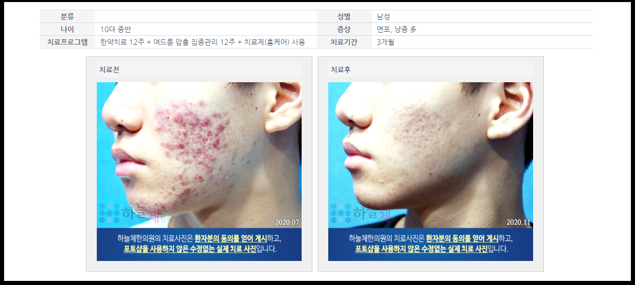 화농성 여드름 원인 파악후 관리 3